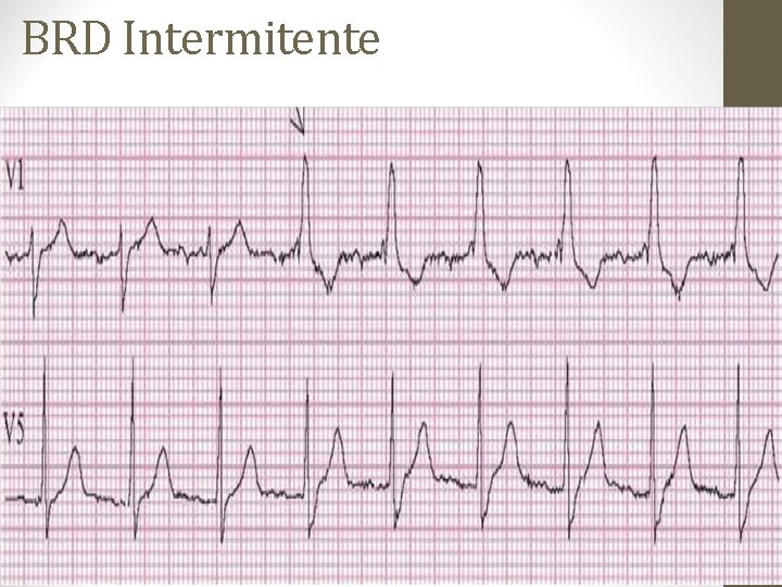 BRD Intermitente BRD Intermitente