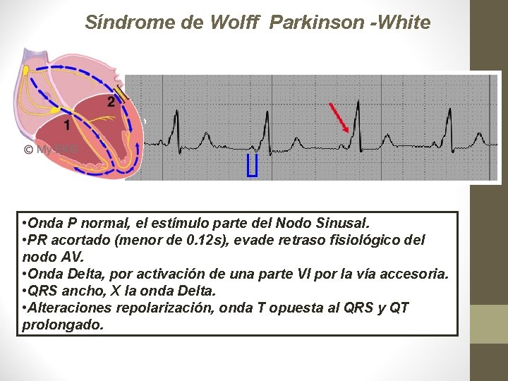 Síndrome de Wolff Parkinson -White • SISTEMA DE CONDUCCIÓN NORMAL. • CONDUCCIÓN POR LA Síndrome de Wolff Parkinson -White • SISTEMA DE CONDUCCIÓN NORMAL. • CONDUCCIÓN POR LA