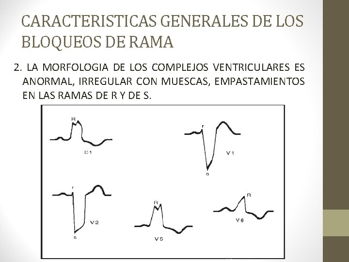 CARACTERISTICAS GENERALES DE LOS BLOQUEOS DE RAMA 2. LA MORFOLOGIA DE LOS COMPLEJOS VENTRICULARES CARACTERISTICAS GENERALES DE LOS BLOQUEOS DE RAMA 2. LA MORFOLOGIA DE LOS COMPLEJOS VENTRICULARES
