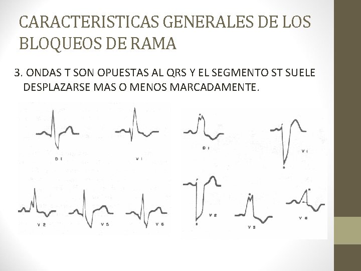 CARACTERISTICAS GENERALES DE LOS BLOQUEOS DE RAMA 3. ONDAS T SON OPUESTAS AL QRS CARACTERISTICAS GENERALES DE LOS BLOQUEOS DE RAMA 3. ONDAS T SON OPUESTAS AL QRS