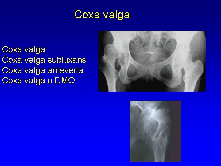 Coxa valga subluxans Coxa valga anteverta Coxa valga u DMO 