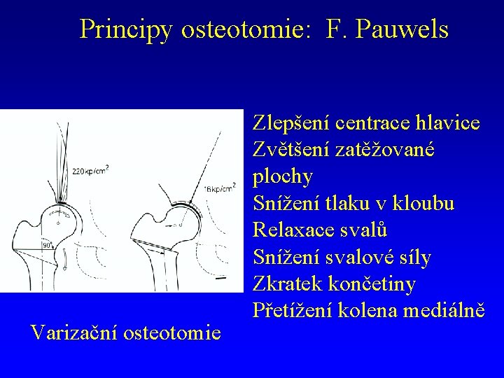 Principy osteotomie: F. Pauwels Varizační osteotomie Zlepšení centrace hlavice Zvětšení zatěžované plochy Snížení tlaku