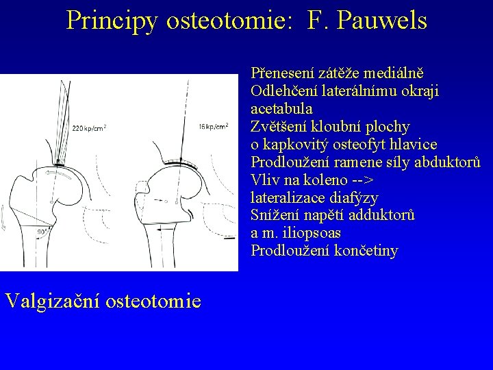 Principy osteotomie: F. Pauwels Přenesení zátěže mediálně Odlehčení laterálnímu okraji acetabula Zvětšení kloubní plochy