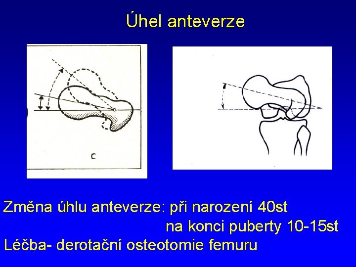 Úhel anteverze Změna úhlu anteverze: při narození 40 st na konci puberty 10 -15