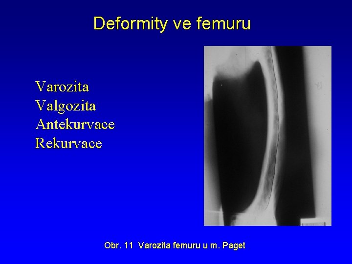 Deformity ve femuru Varozita Valgozita Antekurvace Rekurvace Obr. 11 Varozita femuru u m. Paget