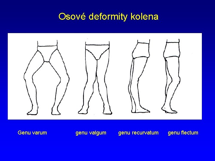 Osové deformity kolena Genu varum genu valgum genu recurvatum genu flectum 