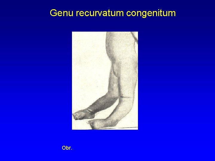 Genu recurvatum congenitum Obr. 