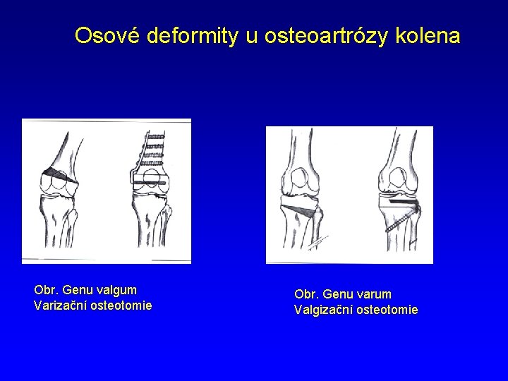 Osové deformity u osteoartrózy kolena Obr. Genu valgum Varizační osteotomie Obr. Genu varum Valgizační