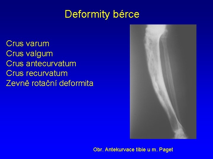 Deformity bérce Crus varum Crus valgum Crus antecurvatum Crus recurvatum Zevně rotační deformita Obr.