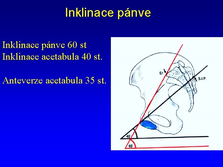 Inklinace pánve 60 st Inklinace acetabula 40 st. Anteverze acetabula 35 st. 