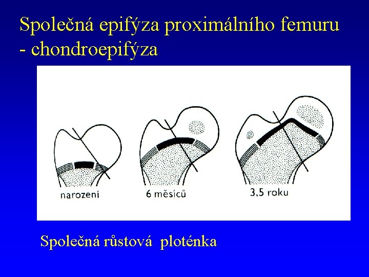 Společná epifýza proximálního femuru - chondroepifýza Společná růstová ploténka 