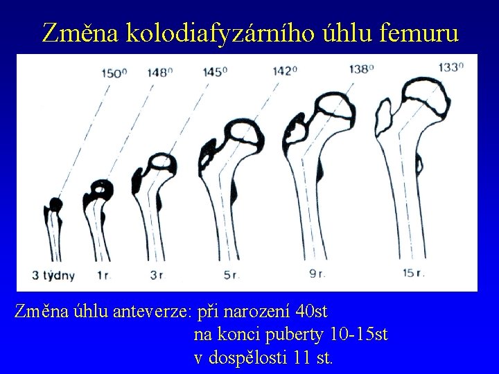 Změna kolodiafyzárního úhlu femuru Změna úhlu anteverze: při narození 40 st na konci puberty