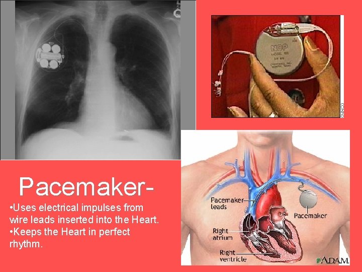 Pacemaker- • Uses electrical impulses from wire leads inserted into the Heart. • Keeps
