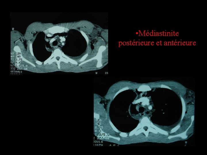  • Médiastinite postérieure et antérieure 