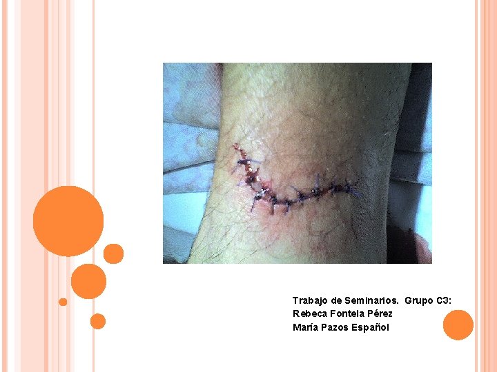 Heridas simples y suturas Trabajo de Seminarios. Grupo C 3: Rebeca Fontela Pérez María