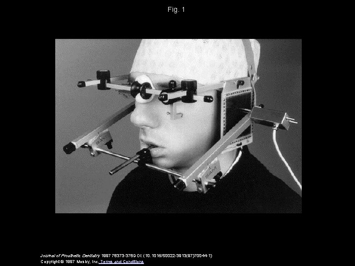 Fig. 1 Journal of Prosthetic Dentistry 1997 78373 -378 DOI: (10. 1016/S 0022 -3913(97)70044