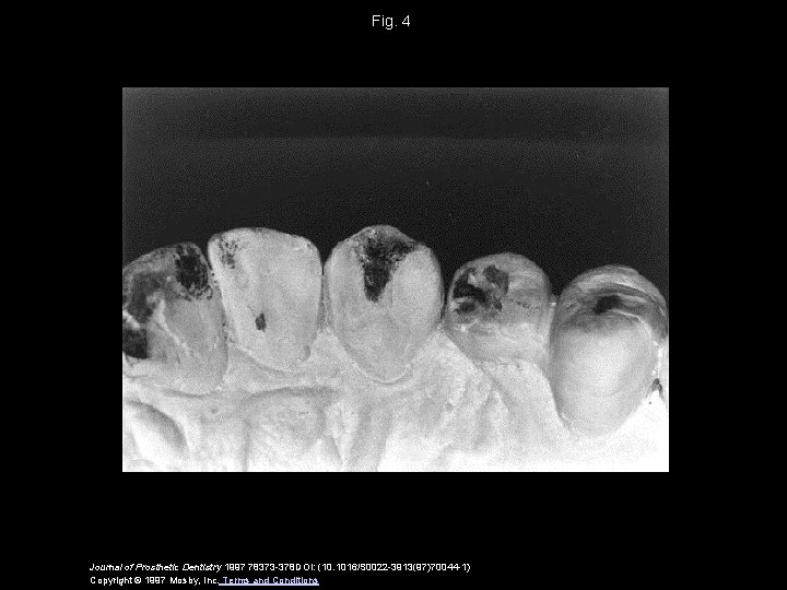 Fig. 4 Journal of Prosthetic Dentistry 1997 78373 -378 DOI: (10. 1016/S 0022 -3913(97)70044