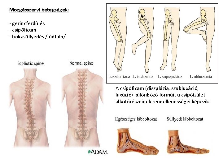 Mozgásszervi betegségek: - gerincferdülés - csípőficam - bokasűllyedés /lúdtalp/ A csípőficam (diszplázia, szubluxáció, luxáció)