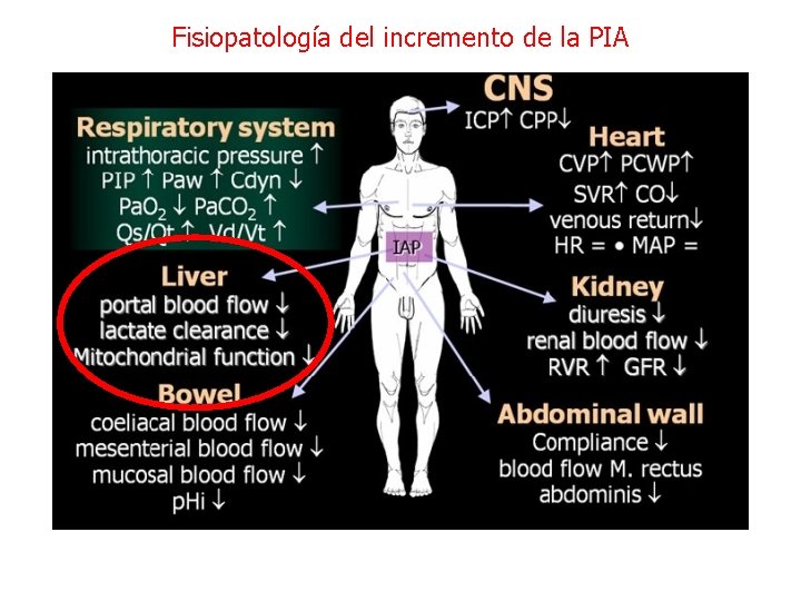 Fisiopatología del incremento de la PIA 