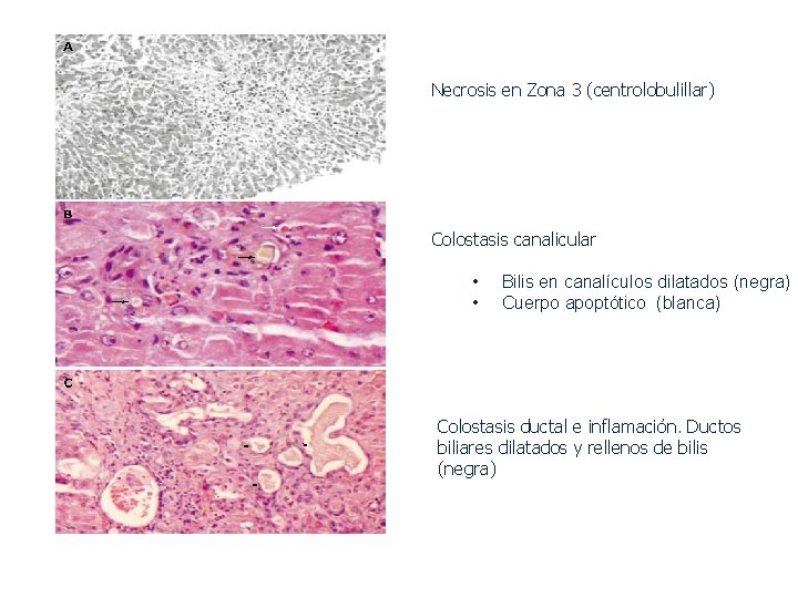 Necrosis en Zona 3 (centrolobulillar) Colostasis canalicular • • Bilis en canalículos dilatados (negra)