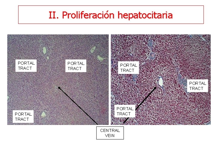 II. Proliferación hepatocitaria PORTAL TRACT PORTAL TRACT CENTRAL VEIN 