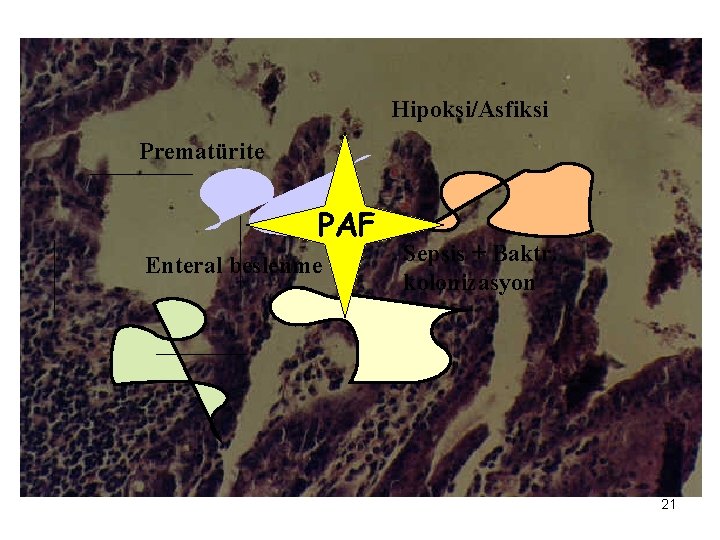 Hipoksi/Asfiksi Prematürite PAF Enteral beslenme Sepsis + Baktr. kolonizasyon 21 