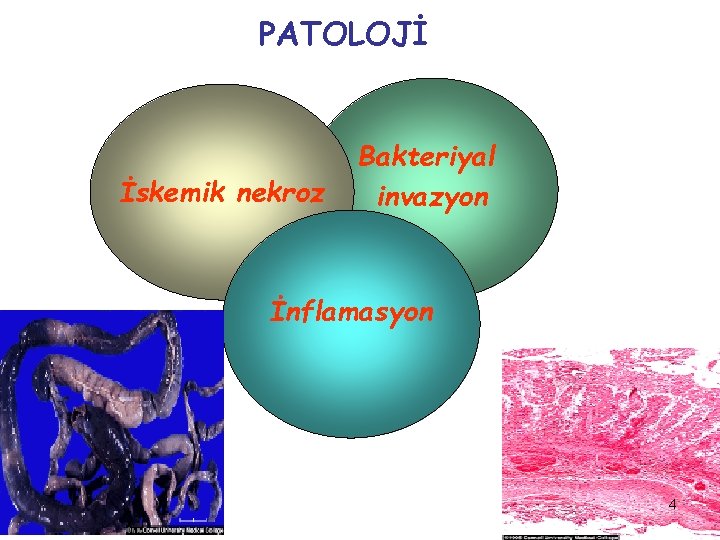 PATOLOJİ İskemik nekroz Bakteriyal invazyon İnflamasyon 4 