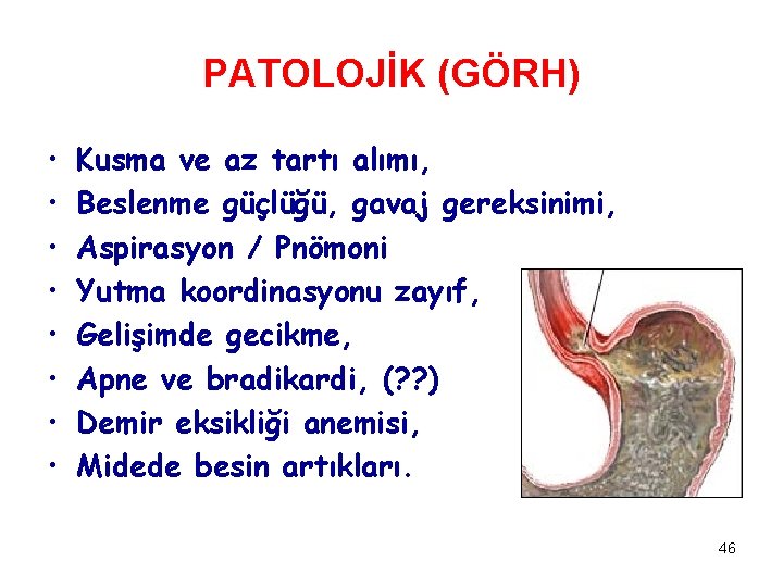 PATOLOJİK (GÖRH) • • Kusma ve az tartı alımı, Beslenme güçlüğü, gavaj gereksinimi, Aspirasyon