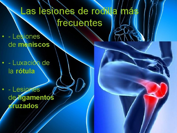 Las lesiones de rodilla más frecuentes • - Lesiones de meniscos • - Luxación