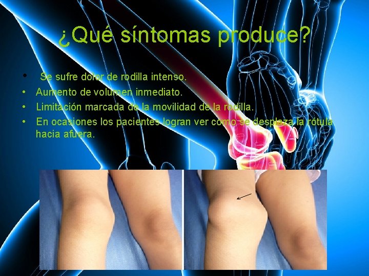 ¿Qué síntomas produce? • Se sufre dolor de rodilla intenso. • Aumento de volumen