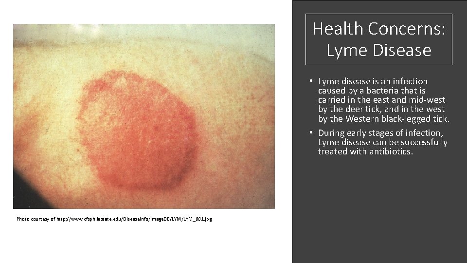 Health Concerns: Lyme Disease • Lyme disease is an infection caused by a bacteria