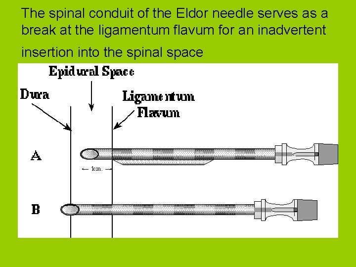 The spinal conduit of the Eldor needle serves as a break at the ligamentum