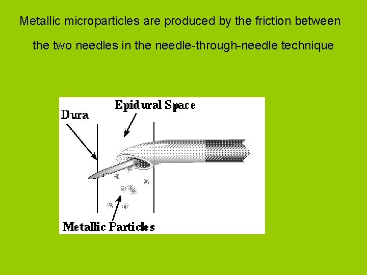 Metallic microparticles are produced by the friction between the two needles in the needle-through-needle