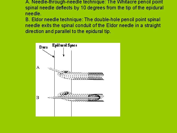 A. Needle-through-needle technique: The Whitacre pencil point spinal needle deflects by 10 degrees from
