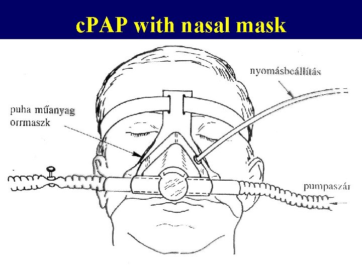 c. PAP with nasal mask 