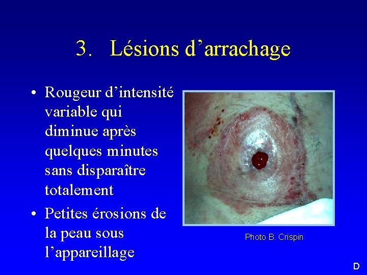 3. Lésions d’arrachage • Rougeur d’intensité variable qui diminue après quelques minutes sans disparaître