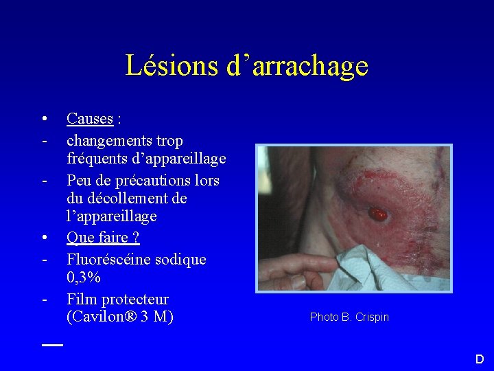 Lésions d’arrachage • • - Causes : changements trop fréquents d’appareillage Peu de précautions