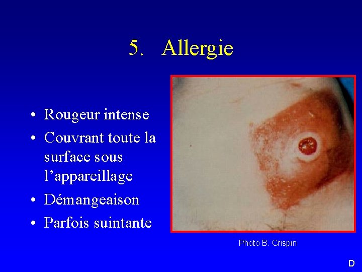 5. Allergie • Rougeur intense • Couvrant toute la surface sous l’appareillage • Démangeaison