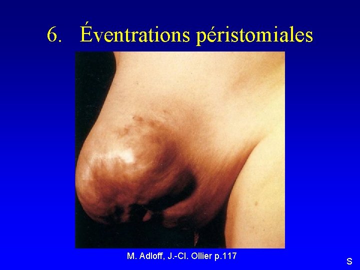 6. Éventrations péristomiales M. Adloff, J. -Cl. Ollier p. 117 S 