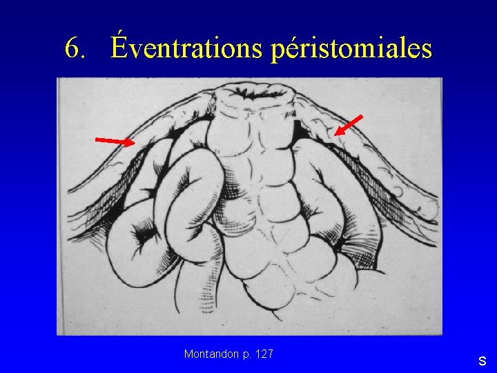 6. Éventrations péristomiales Montandon p. 127 S 