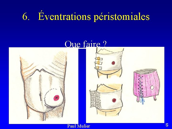 6. Éventrations péristomiales Que faire ? Paul Mulier S 