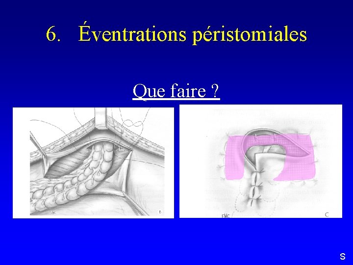 6. Éventrations péristomiales Que faire ? S 