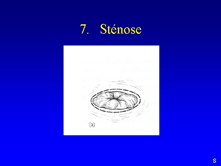 7. Sténose S 