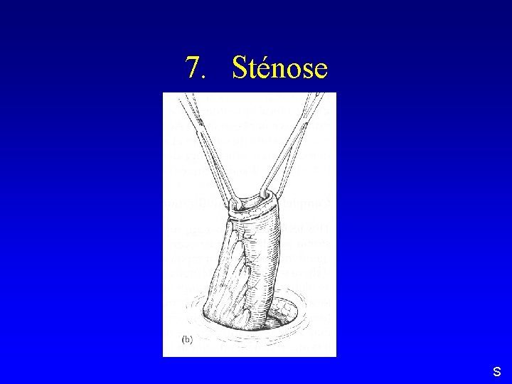 7. Sténose S 