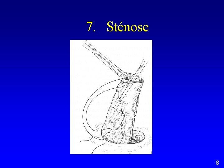 7. Sténose S 