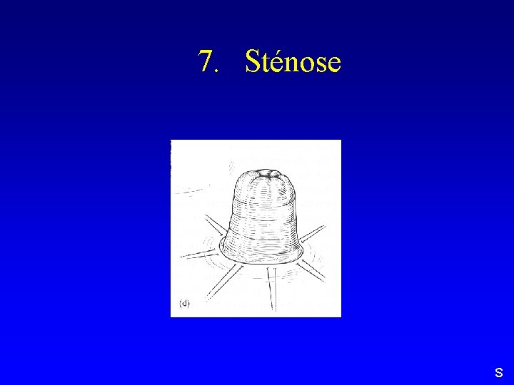 7. Sténose S 