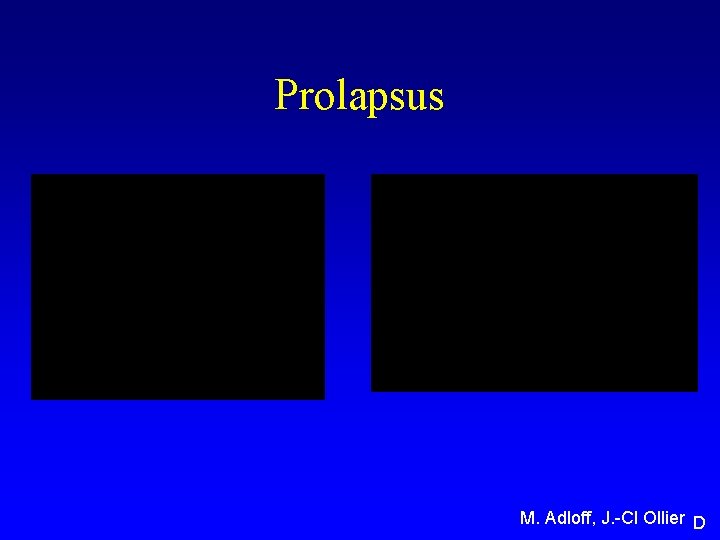 Prolapsus M. Adloff, J. -Cl Ollier D 