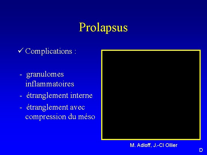 Prolapsus ü Complications : - granulomes inflammatoires - étranglement interne - étranglement avec compression