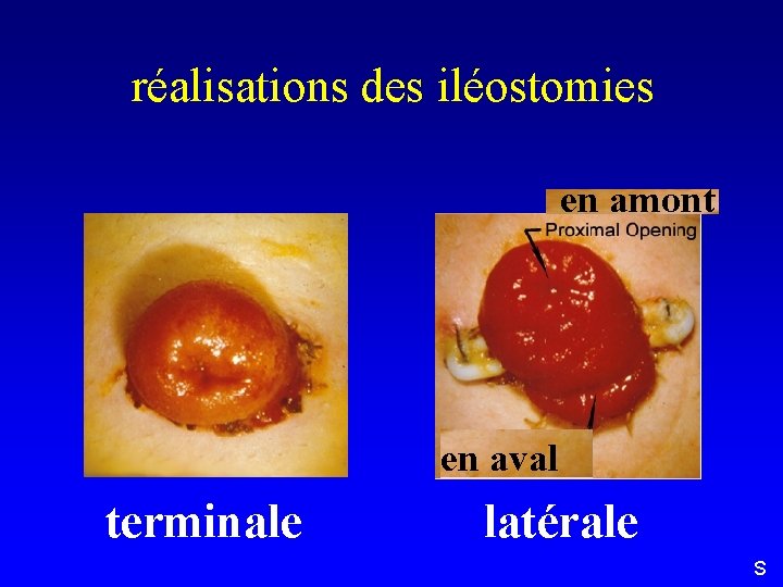 réalisations des iléostomies en amont en aval terminale latérale S 