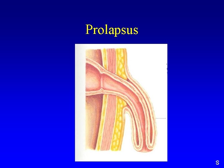 Prolapsus S 